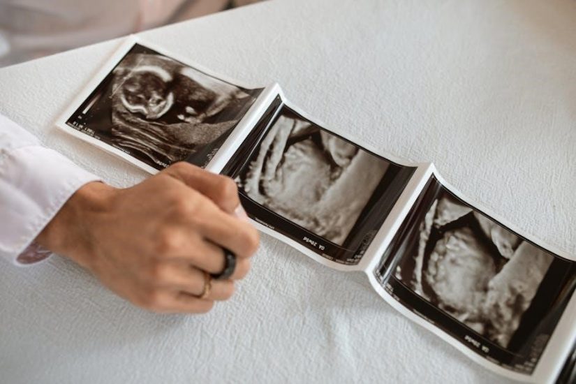 ultrasound guided sclerotherapy